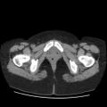 Bicornuate uterus- on MRI (Radiopaedia 49206-54296 Axial non-contrast 15).jpg