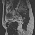 Bicornuate uterus (Radiopaedia 24677-24949 B 1).jpg
