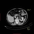 Bifid ureter (Radiopaedia 47604-52253 Axial C+ delayed 7).jpg