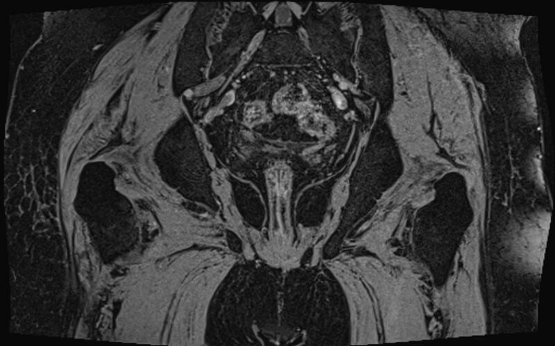 File:Bilateral avascular necrosis of femoral head (Radiopaedia 77116-89078 Coronal T2 we 5).jpg