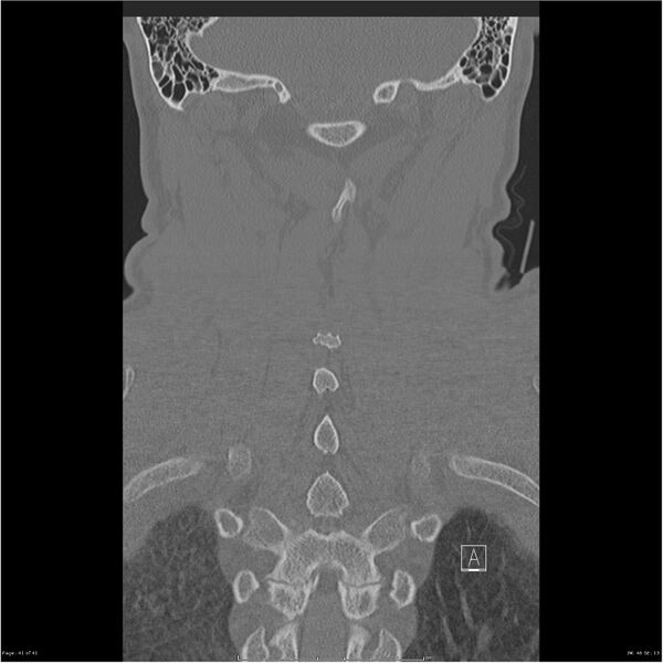 File:Bilateral cervical ribs (Radiopaedia 25868-26017 Coronal bone window 41).jpg