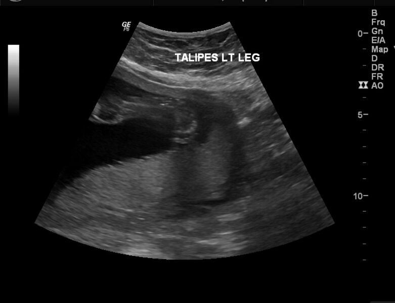 File:Bilateral congenital talipes equino-varus deformity in fetus (Radiopaedia 23337-23412 C 1).jpg