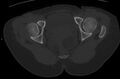 Bilateral mature cystic ovarian teratoma (Radiopaedia 88821-105592 Axial bone window 47).jpg
