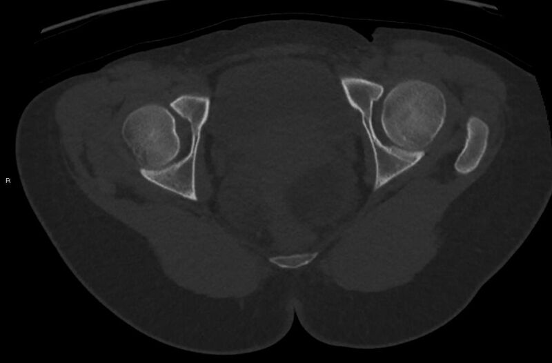 File:Bilateral mature cystic ovarian teratoma (Radiopaedia 88821-105592 Axial bone window 47).jpg
