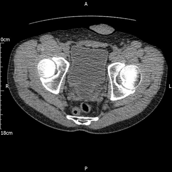 File:Bilateral medullary nephrocalcinosis with ureteric calculi (Radiopaedia 71269-81569 Axial non-contrast 123).jpg