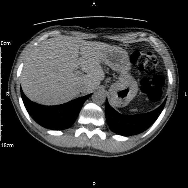 File:Bilateral medullary nephrocalcinosis with ureteric calculi (Radiopaedia 71269-81569 Axial non-contrast 13).jpg