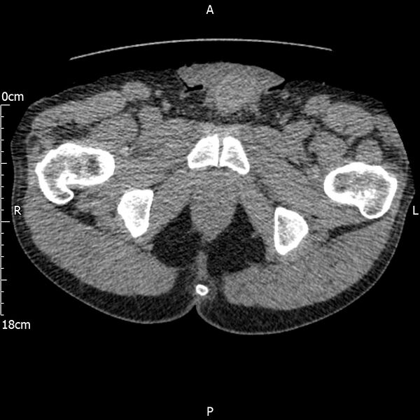 File:Bilateral medullary nephrocalcinosis with ureteric calculi (Radiopaedia 71269-81569 Axial non-contrast 138).jpg