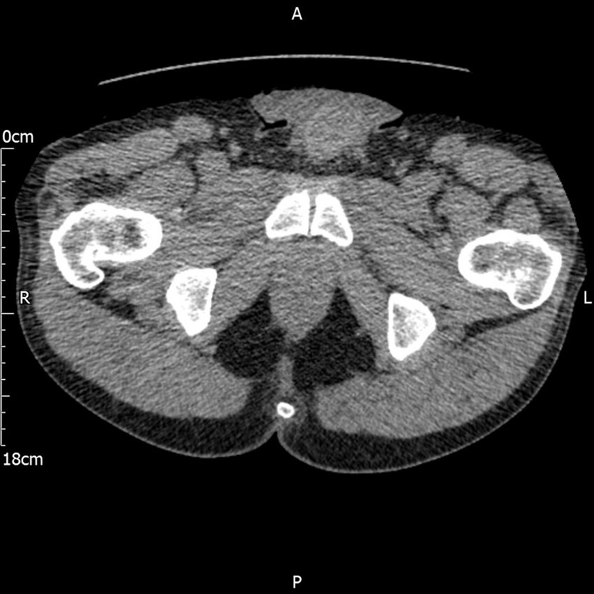 Bilateral medullary nephrocalcinosis with ureteric calculi (Radiopaedia 71269-81569 Axial non-contrast 138).jpg