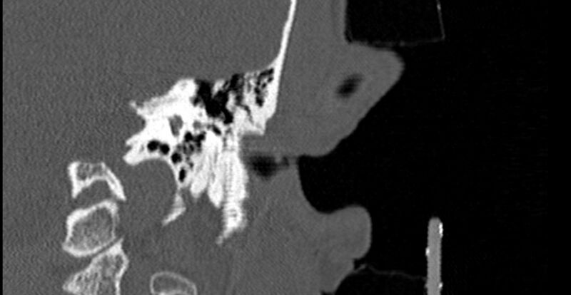 File:Bilateral temporal bone fractures (Radiopaedia 29482-29970 Coronal 199).jpg