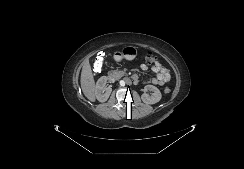 File:Bilateral urolithiasis with incidentally detected splenic artery aneurysm and left inferior vena cava (Radiopaedia 44467-48130 Mutiple 3).jpg