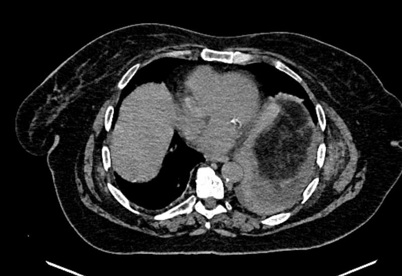 File:Biliary pancreatitis (Radiopaedia 72289-82823 Axial non-contrast 19).jpg
