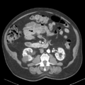 Bladder papillary urothelial carcinoma (Radiopaedia 48119-52951 A 23).png