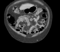 Bladder papillary urothelial carcinoma (Radiopaedia 48119-52951 C 13).png
