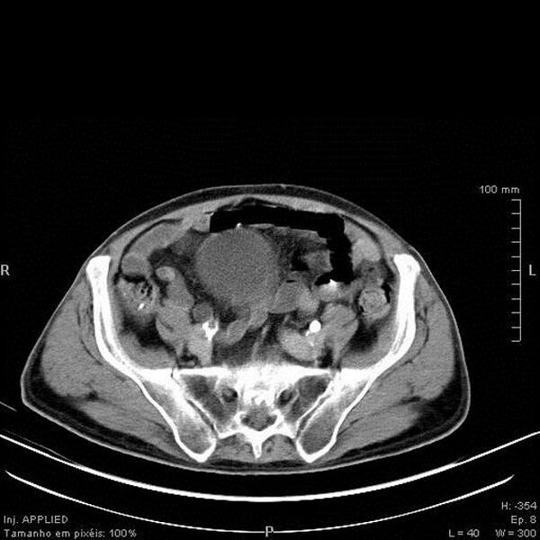 File:Bladder squamous cell carcinoma (Radiopaedia 14130-13984 C 1).jpg