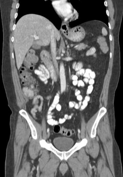 File:Bleeding duodenal ulcer and adenomyomatosis of gallbladder (Radiopaedia 61834-69861 B 44).jpg