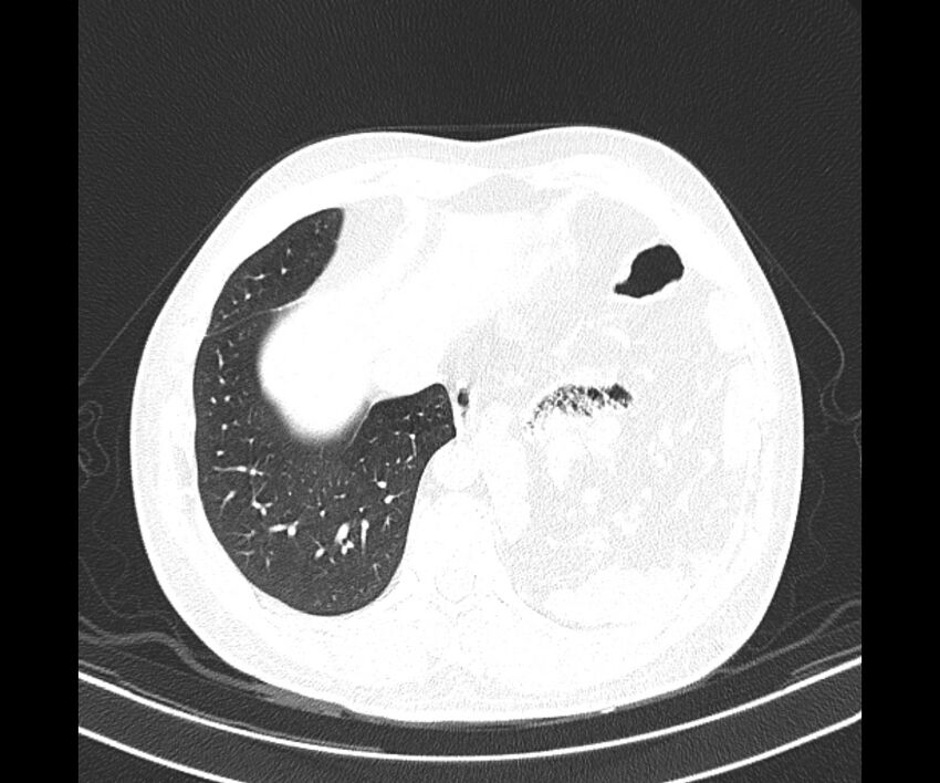 Bochdalek hernia - adult presentation (Radiopaedia 74897-85925 Axial lung window 36).jpg