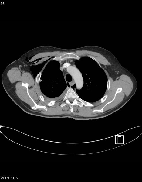 File:Boerhaave syndrome with tension pneumothorax (Radiopaedia 56794-63605 A 17).jpg