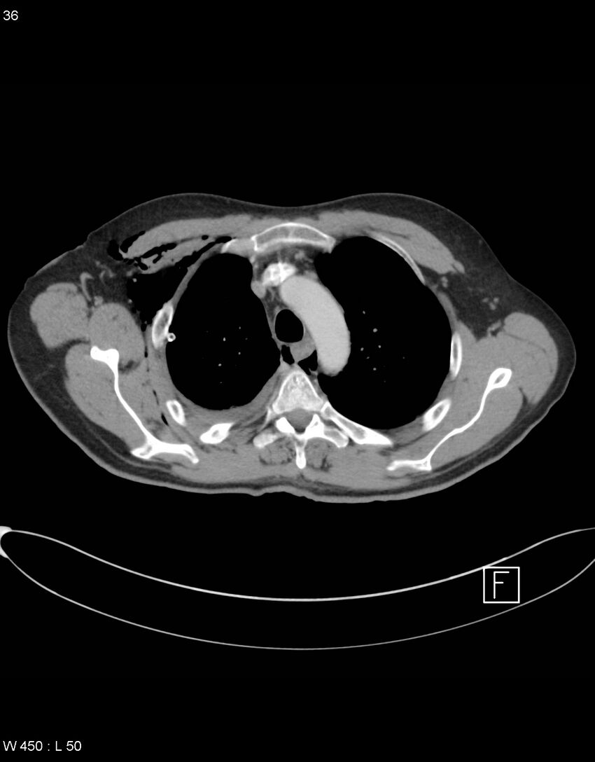 Boerhaave syndrome with tension pneumothorax (Radiopaedia 56794-63605 A 17).jpg