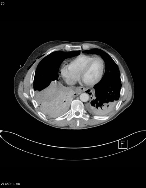 File:Boerhaave syndrome with tension pneumothorax (Radiopaedia 56794-63605 A 35).jpg