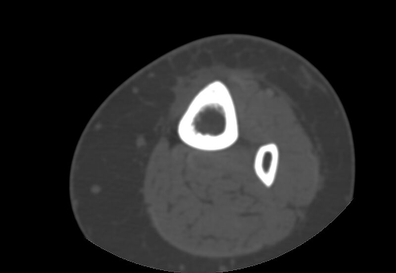 File:Bone metastasis - tibia (Radiopaedia 57665-64609 Axial bone window 12).jpg