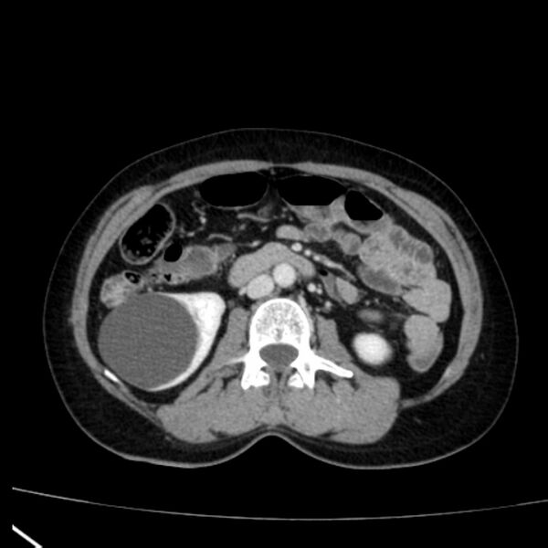 File:Bosniak renal cyst - type I (Radiopaedia 27479-27675 C 42).jpg