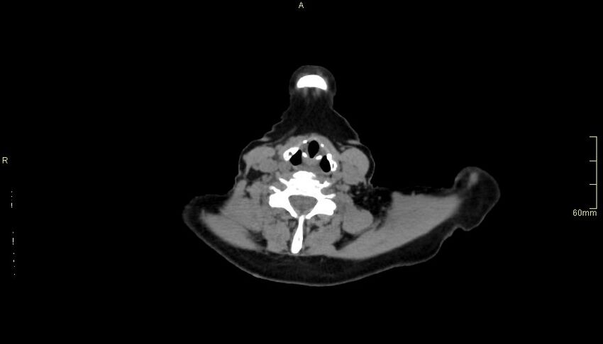 Brachial artery foreign body (Radiopaedia 54583-60820 Axial non-contrast 2).jpg