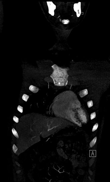 File:Brachiocephalic trunk pseudoaneurysm (Radiopaedia 70978-81191 B 15).jpg