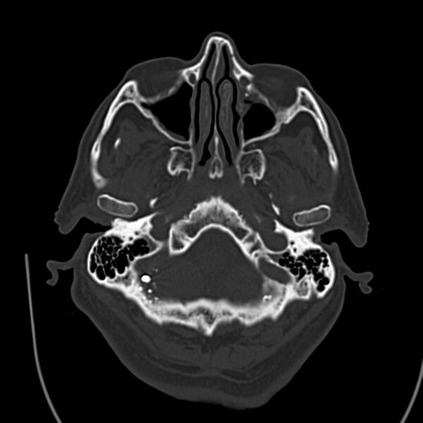 File:Brain Pantopaque remnants (Radiopaedia 78403-91048 Axial bone window 17).jpg