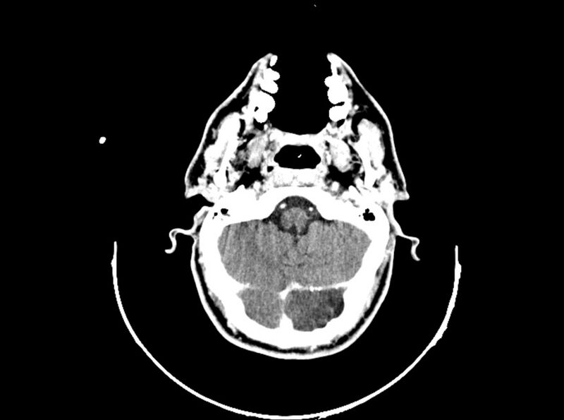 File:Brain injury by firearm projectile (Radiopaedia 82068-96088 B 72).jpg