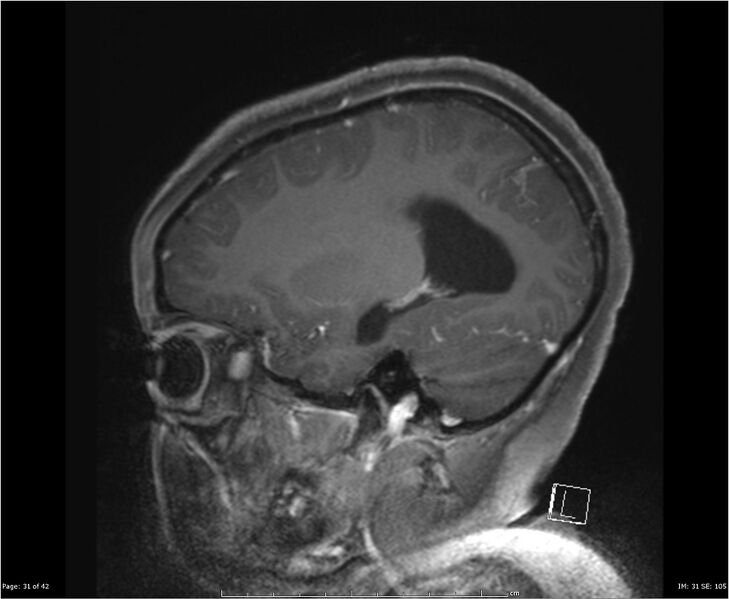 File:Brainstem glioma (Radiopaedia 21819-21775 D 31).jpg