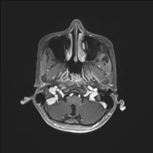 File:Brainstem glioma (Radiopaedia 70548-80674 Axial T1 C+ 27).jpg