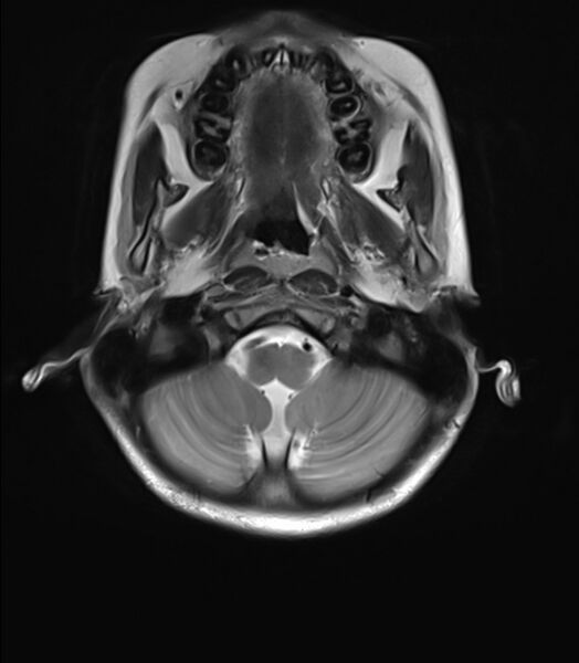 File:Brainstem glioma (Radiopaedia 70548-80674 Axial T2 3).jpg