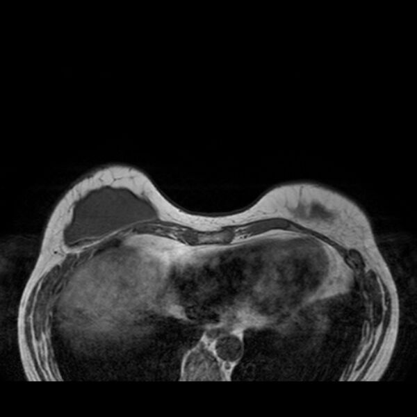 File:Breast implants - MRI (Radiopaedia 26864-27035 Axial T1 11).jpg