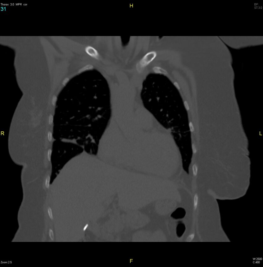 Breast primary with lung and bone metastases (Radiopaedia 40620-43228 bone window 31).jpg