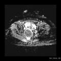 Broad ligament fibroid (Radiopaedia 49135-54241 Axial ADC 20).jpg