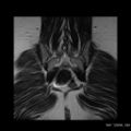 Broad ligament fibroid (Radiopaedia 49135-54241 Coronal T2 23).jpg
