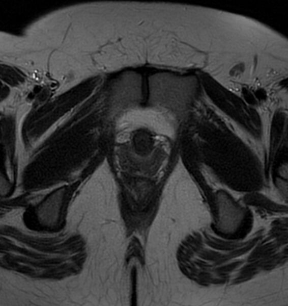 File:Broad ligament leiomyoma (Radiopaedia 81634-95516 Axial T2 25).jpg
