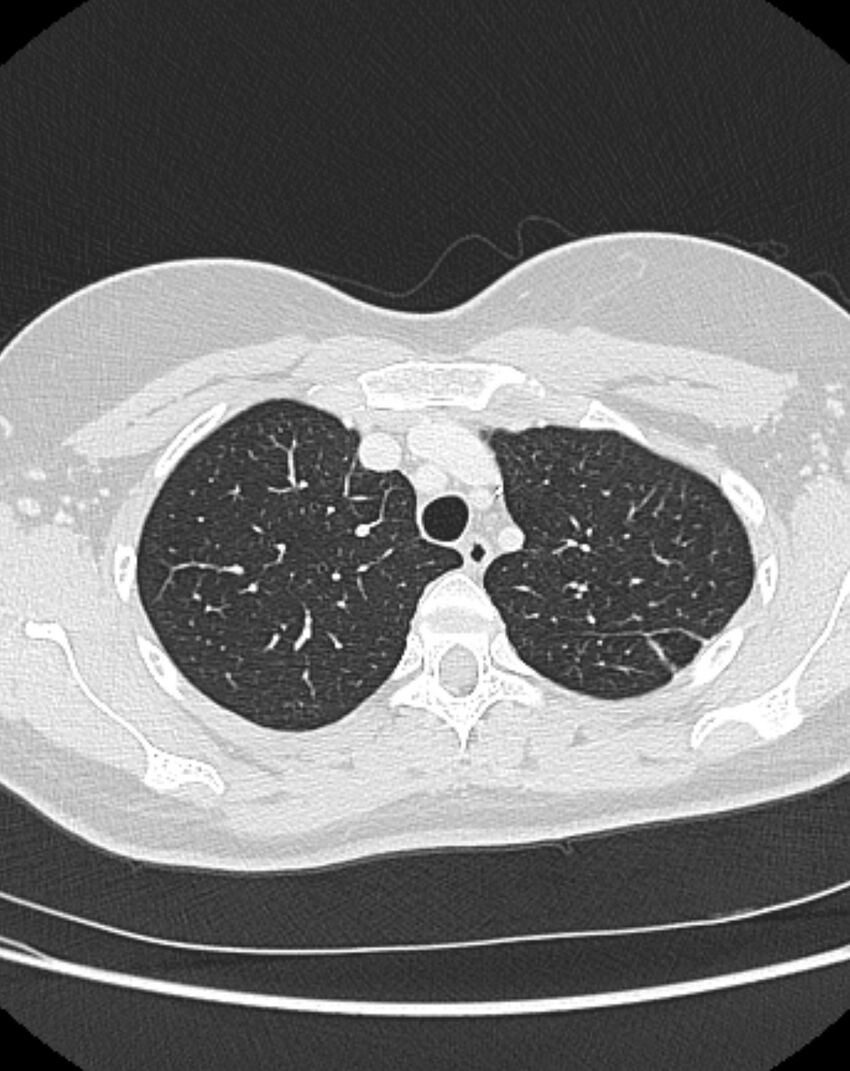 Bronchial atresia (Radiopaedia 50007-55297 Axial lung window 19).jpg