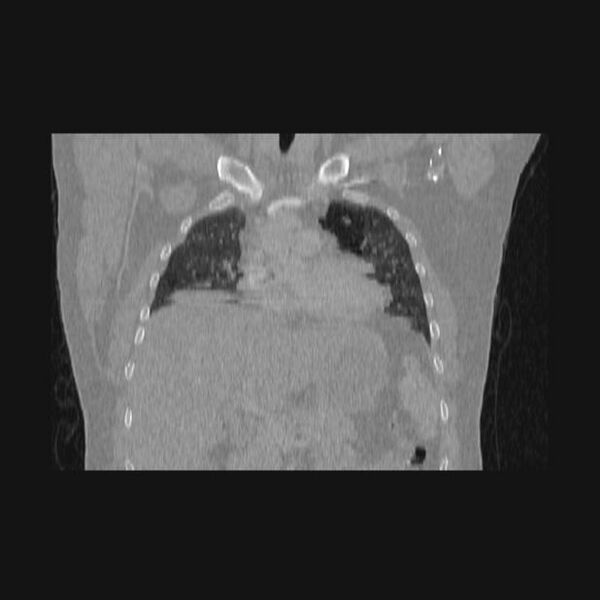 File:Bronchial atresia (Radiopaedia 60685-68439 Coronal lung window 47).jpg