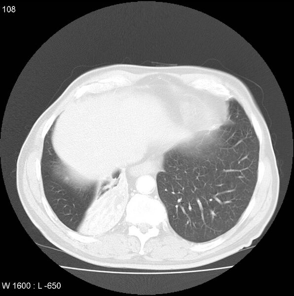 File:Bronchial carcinoid tumor with right lower lobe collapse (Radiopaedia 29060-29422 B 46).jpg