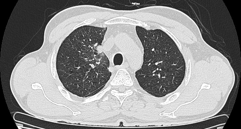 File:Bronchogenic carcinoma with superior vena cava syndrome (Radiopaedia 36497-38054 Axial lung window 30).jpg