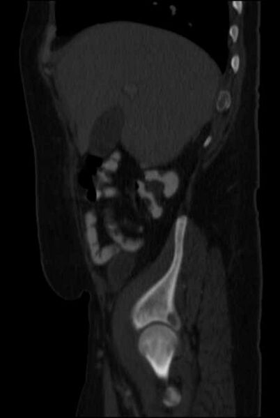 File:Brown tumors compressing the spinal cord (Radiopaedia 68442-77988 H 15).jpg