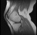 Bucket handle tear - medial meniscus (Radiopaedia 24900-25163 Sagittal T2 12).png