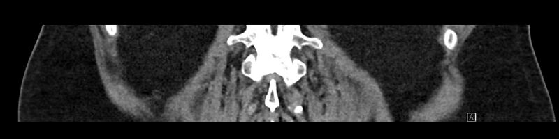 File:Buried bumper syndrome - gastrostomy tube (Radiopaedia 63843-72575 Coronal Inject 82).jpg