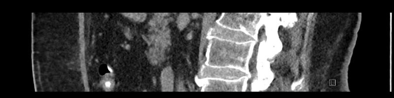File:Buried bumper syndrome - gastrostomy tube (Radiopaedia 63843-72575 Sagittal Inject 67).jpg