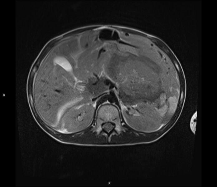 File:Burkitt lymphoma (bowel) (Radiopaedia 68839-78557 Axial T2 21).jpg