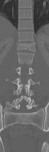 File:Burst fracture - T12 with conus compression (Radiopaedia 56825-63647 Coronal bone window 21).png