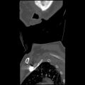C1 anterior arch (plough) fracture - type 1 (Radiopaedia 76181-87720 Sagittal bone window 6).jpg