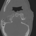 C2 fracture with vertebral artery dissection (Radiopaedia 37378-39199 Axial bone window 13).png