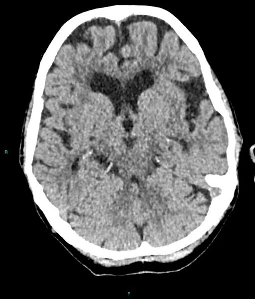 File:Calcified cerebral emboli from left ventricular thrombus (Radiopaedia 84420-99758 Axial non-contrast 60).jpg